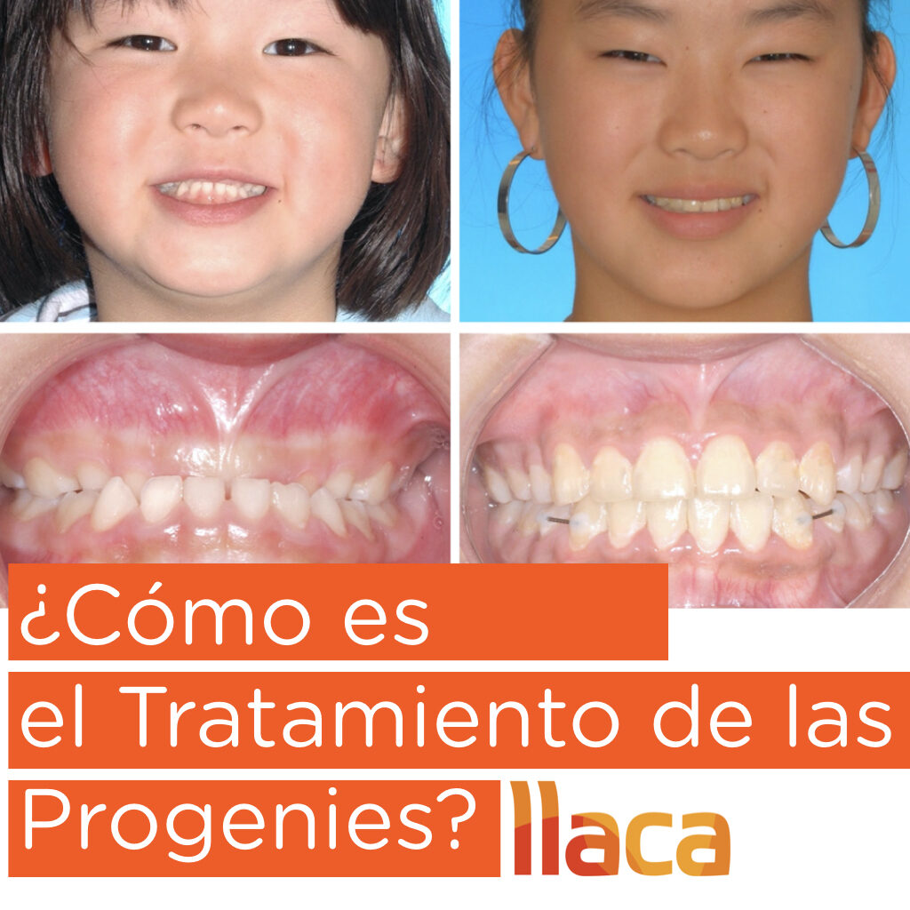 Tratamiento de Progenies - LLACA ortodoncia Oviedo