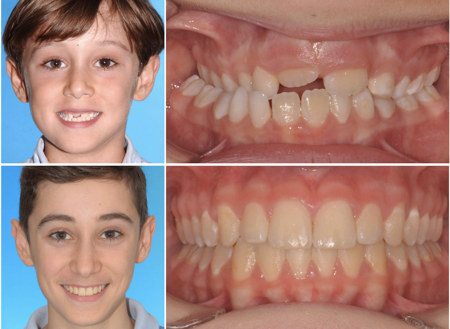 Precio De Los Brackets Para Niños. 3 Aspectos A Tener En Cuenta - LLACA ...