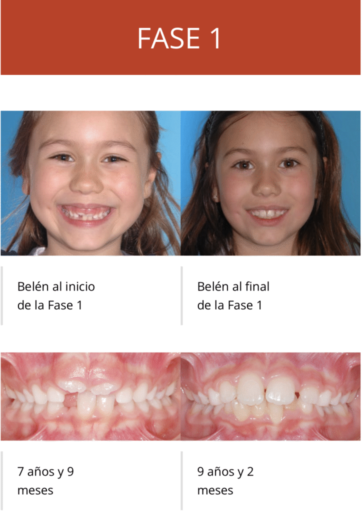 Tratamiento en 2 Fases de Ortodoncia con disyunción del paladar