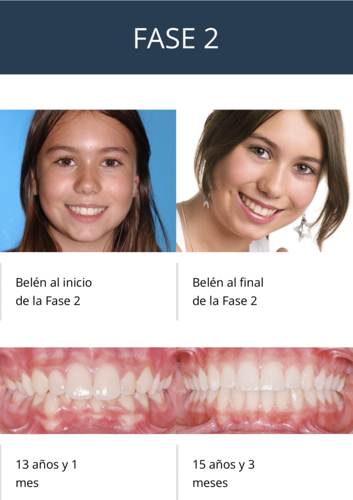 Tratamiento en 2 Fases de Ortodoncia con disyunción del paladar